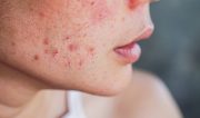 closeup acne on woman's face with rash skin ,scar and spot that allergic to cosmetics